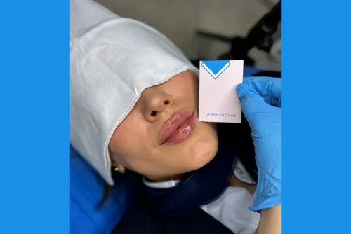 همه چیز درباره تزریق فیلر لب